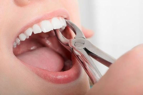 wisdom tooth removal extraction in gurgaon